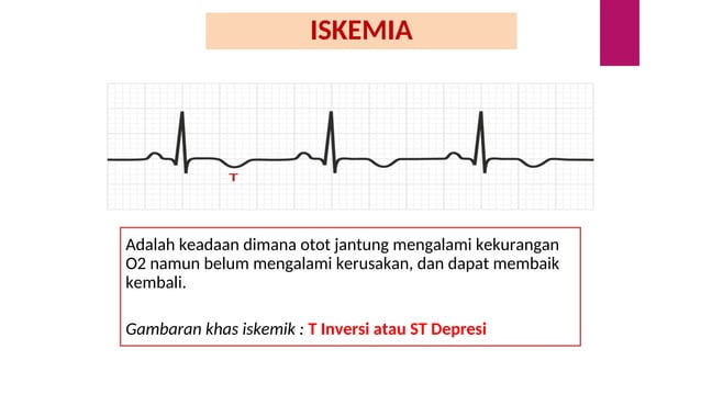 Interpretasi Gambaran EKG Bagi pemula.ppt