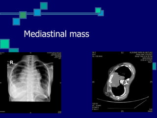 Mediastinal mass 