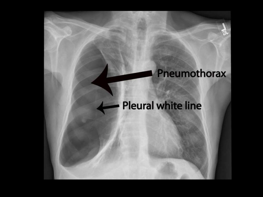 Interpretation of x ray in disease process