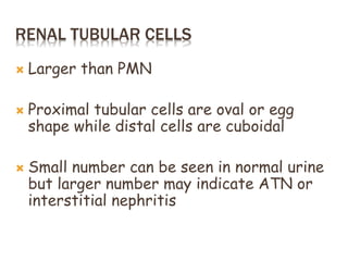 RENAL TUBULAR CELLS
 Larger than PMN
 Proximal tubular cells are oval or egg
shape while distal cells are cuboidal
 Small number can be seen in normal urine
but larger number may indicate ATN or
interstitial nephritis
 