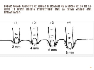 EDEMA SCALE. SEVERITY OF EDEMA IS RANKED ON A SCALE OF +1 TO +4,
WITH +1 BEING BARELY PERCEPTIBLE AND +4 BEING VISIBLE AND
REMARKABLE.
30
 