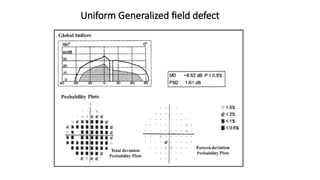 INTERPRETATION OF AUTOMATED PERIMETRY.pptx
