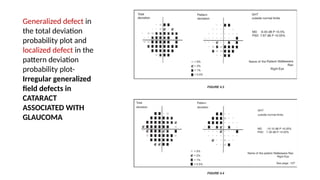 Deviation Defect INTERPRETATION OF AUTOMATED PERIMETRY.pptx