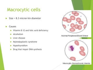Macrocytic cells
 Size > 8.3 micron kin diameter
 Causes
 Vitamin B 12 and folic acid deficiency
 Alcoholism
 Liver disease
 Myleodysplastic syndrome
 Hypothyroidism
 Drug that impair DNA synthesis
 
