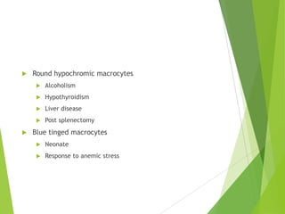  Round hypochromic macrocytes
 Alcoholism
 Hypothyroidism
 Liver disease
 Post splenectomy
 Blue tinged macrocytes
 Neonate
 Response to anemic stress
 