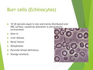 Burr cells (Echinocytes)
 10-30 spicules equal in size and evenly distributed over
RBC surface; caused by alteration in extracellular
environment
 Seen in
 Liver disease
 Renal failure
 Dehydration
 Pyruvate kinase deficiency
 Storage artefacts
 