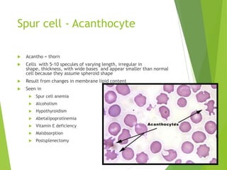 Spur cell - Acanthocyte
 Acantho = thorn
 Cells with 5-10 specules of varying length, irregular in
shape, thickness, with wide bases and appear smaller than normal
cell because they assume spheroid shape
 Result from changes in membrane lipid content
 Seen in
 Spur cell anemia
 Alcoholism
 Hypothyroidism
 Abetalipoprotinemia
 Vitamin E deficiency
 Malsbsorption
 Postsplenectomy
 