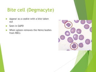 Bite cell (Degmacyte)
 Appear as a cookie with a bite taken
out
 Seen in G6PD
 When spleen removes the Heinz bodies
from RBCs
 