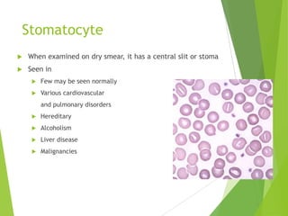 Stomatocyte
 When examined on dry smear, it has a central slit or stoma
 Seen in
 Few may be seen normally
 Various cardiovascular
and pulmonary disorders
 Hereditary
 Alcoholism
 Liver disease
 Malignancies
 