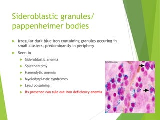 Sideroblastic granules/
pappenheimer bodies
 Irregular dark blue iron containing granules occuring in
small clusters, predominantly in periphery
 Seen in
 Sideroblastic anemia
 Spleenectomy
 Haemolytic anemia
 Myelodysplastic syndromes
 Lead poisoining
 Its presence can rule out iron deficiency anemia
 