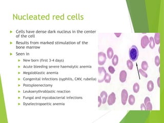 Nucleated red cells
 Cells have dense dark nucleus in the center
of the cell
 Results from marked stimulation of the
bone marrow
 Seen in
 New born (first 3-4 days)
 Acute bleeding severe haemolytic anemia
 Megaloblastic anemia
 Congenital infections (syphilis, CMV, rubella)
 Postspleenectomy
 Leukoerythroblastic reaction
 Fungal and mycobacterial infections
 Dyselectropoeitic anemia
 