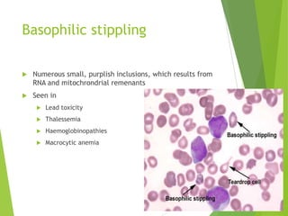Basophilic stippling
 Numerous small, purplish inclusions, which results from
RNA and mitochrondrial remenants
 Seen in
 Lead toxicity
 Thalessemia
 Haemoglobinopathies
 Macrocytic anemia
 