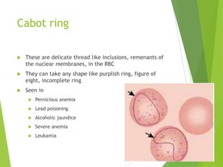 Cabot ring
 These are delicate thread like inclusions, remenants of
the nuclear membranes, in the RBC
 They can take any shape like purplish ring, figure of
eight, incomplete ring
 Seen in
 Pernicious anemia
 Lead poisoning
 Alcoholic jaundice
 Severe anemia
 Leukamia
 