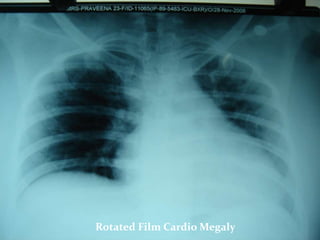 Interpretation of chest x ray | PPTX