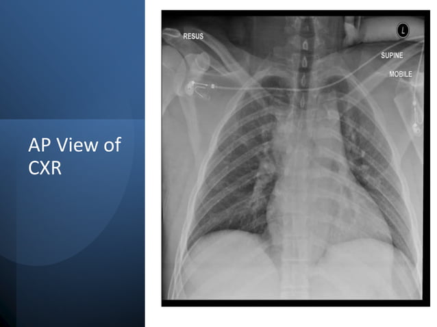 Interpretation of chest xray ppt | PPTX