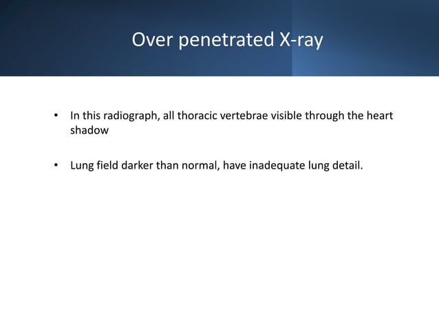 Interpretation of chest xray ppt | PPTX