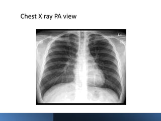 Interpretation of chest xray ppt | PPTX