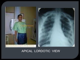 APICAL LORDOTIC VIEW
 