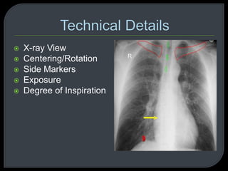 R
 X-ray View
 Centering/Rotation
 Side Markers
 Exposure
 Degree of Inspiration
 