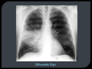 Silhouette Sign
 