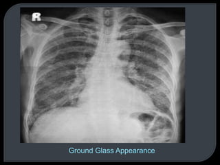 Ground Glass Appearance
 