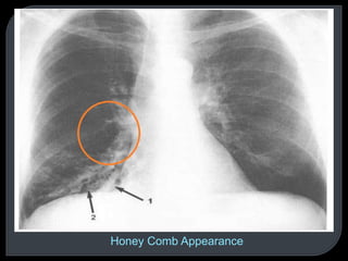 Honey Comb Appearance