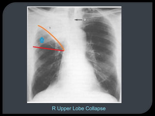 R Upper Lobe Collapse
 