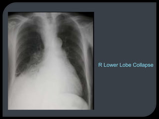 R Lower Lobe Collapse
 