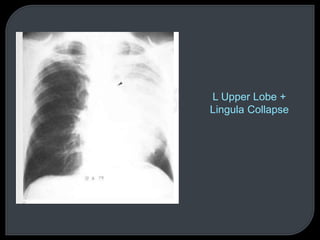 L Upper Lobe +
Lingula Collapse
 