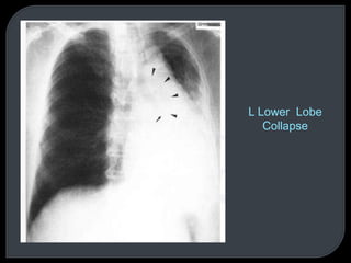 L Lower Lobe
Collapse
 