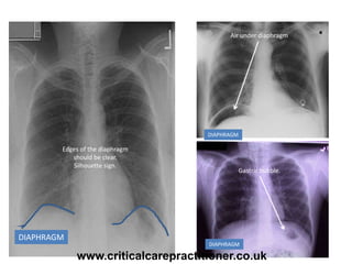 DIAPHRAGM
Edges of the diaphragm
should be clear.
Silhouette sign.
Air under diaphragm
Gastric bubble.
DIAPHRAGM
DIAPHRAGM
www.criticalcarepractitioner.co.uk
 