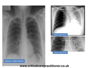EQUAL LUNG FIELDS
Equal translucency
Air Bronchograms
EQUAL LUNG FIELDS
EQUAL LUNG FIELDS
www.criticalcarepractitioner.co.uk
 
