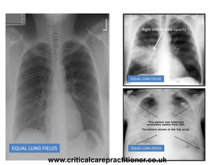 Right middle lobe opacity
EQUAL LUNG FIELDS
EQUAL LUNG FIELDS
EQUAL LUNG FIELDS
www.criticalcarepractitioner.co.uk
 