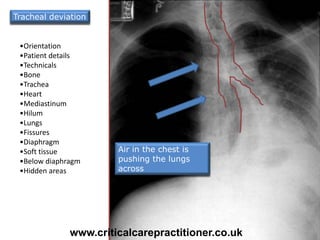•Orientation
•Patient details
•Technicals
•Bone
•Trachea
•Heart
•Mediastinum
•Hilum
•Lungs
•Fissures
•Diaphragm
•Soft tissue
•Below diaphragm
•Hidden areas
26
Air in the chest is
pushing the lungs
across
Tracheal deviation
www.criticalcarepractitioner.co.uk
 