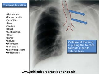 Collapse of the lung
is pulling the trachea
towards it due to
volume loss.
•Orientation
•Patient details
•Technicals
•Bone
•Trachea
•Heart
•Mediastinum
•Hilum
•Lungs
•Fissures
•Diaphragm
•Soft tissue
•Below diaphragm
•Hidden areas
Tracheal deviation
www.criticalcarepractitioner.co.uk
 