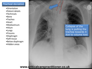 Collapse of the
lung is pulling the
trachea towards it
due to volume loss
•Orientation
•Patient details
•Technicals
•Bone
•Trachea
•Heart
•Mediastinum
•Hilum
•Lungs
•Fissures
•Diaphragm
•Soft tissue
•Below diaphragm
•Hidden areas
Tracheal deviation
www.criticalcarepractitioner.co.uk
 