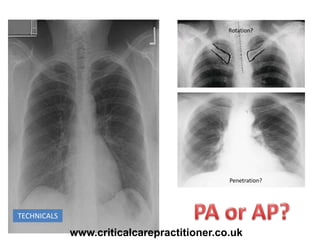 The structured interpretation of chest x rays. | PPTX