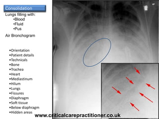 Lungs filling with:
•Blood
•Fluid
•Pus
•Orientation
•Patient details
•Technicals
•Bone
•Trachea
•Heart
•Mediastinum
•Hilum
•Lungs
•Fissures
•Diaphragm
•Soft tissue
•Below diaphragm
•Hidden areas
Air Bronchogram
Consolidation
www.criticalcarepractitioner.co.uk
 