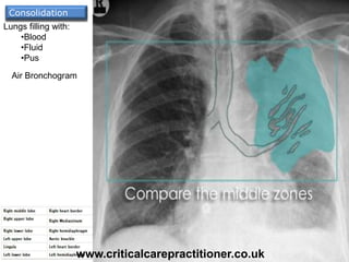 Lungs filling with:
•Blood
•Fluid
•Pus
Air Bronchogram
Consolidation
www.criticalcarepractitioner.co.uk
 