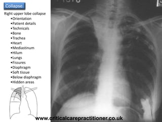 Collapse of the
lung is pulling the
trachea towards it
due to volume loss
•Orientation
•Patient details
•Technicals
•Bone
•Trachea
•Heart
•Mediastinum
•Hilum
•Lungs
•Fissures
•Diaphragm
•Soft tissue
•Below diaphragm
•Hidden areas
Horizontal fissure
pulled upwards
Right upper lobe collapse
Collapse
www.criticalcarepractitioner.co.uk
 