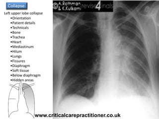 Collapse
•Orientation
•Patient details
•Technicals
•Bone
•Trachea
•Heart
•Mediastinum
•Hilum
•Lungs
•Fissures
•Diaphragm
•Soft tissue
•Below diaphragm
•Hidden areas
Left upper lobe collapse
www.criticalcarepractitioner.co.uk
 