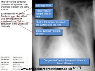 This 68 year old gentleman
presented with gradual onset
shortness of breath and frothy
sputum.
Examination of the chest:
Displaced apex beat, raised
JVP, diminished breath
sounds and stony dull
percussion at the lung bases
bilaterally.
Enlarged heart.
High pressure
in right side of
heart
Fluid in the lung or between
the surface and the lung
Stony dullness= pleural
effusion
Congestive Cardiac failure with bilateral
pleural effusions
www.criticalcarepractitioner.co.uk
 