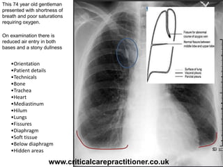 This 74 year old gentleman
presented with shortness of
breath and poor saturations
requiring oxygen.
On examination there is
reduced air entry in both
bases and a stony dullness
•Orientation
•Patient details
•Technicals
•Bone
•Trachea
•Heart
•Mediastinum
•Hilum
•Lungs
•Fissures
•Diaphragm
•Soft tissue
•Below diaphragm
•Hidden areas
www.criticalcarepractitioner.co.uk
 
