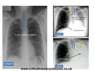 AIRWAY
Is the trachea central? AIRWAY
Has the trachea been
pushed across?
Pneumothorax
Has the trachea been
pulled across?
Consolidation
AIRWAY
www.criticalcarepractitioner.co.uk
 