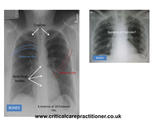 BONES
Posterior ribs
Anterior ribs
Clavicles
Verterbral
bodies
Evidence of fractures?
BONES
6 Anterior or 10 Posterior
ribs.
www.criticalcarepractitioner.co.uk
 