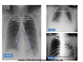 CARDIAC
Edges of the heart and
mediastinum should be clear.
Silhouette sign.
Left lower lobe opacity
Left upper lobe opacity
CARDIAC
CARDIAC
www.criticalcarepractitioner.co.uk
 