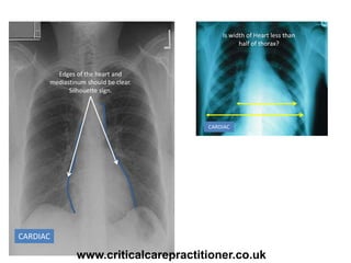 CARDIAC
Edges of the heart and
mediastinum should be clear.
Silhouette sign.
Is width of Heart less than
half of thorax?
CARDIAC
www.criticalcarepractitioner.co.uk
 