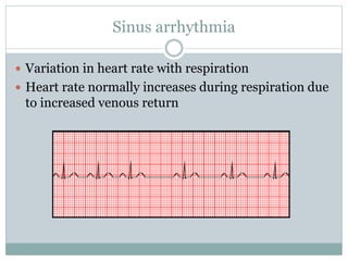 Sinus arrhythmia
 Variation in heart rate with respiration
 Heart rate normally increases during respiration due
to increased venous return
 