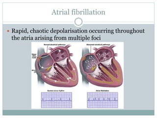 Atrial fibrillation
 Rapid, chaotic depolarisation occurring throughout
the atria arising from multiple foci
 