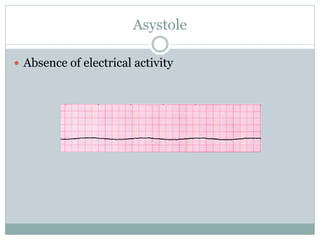 Asystole
 Absence of electrical activity
 